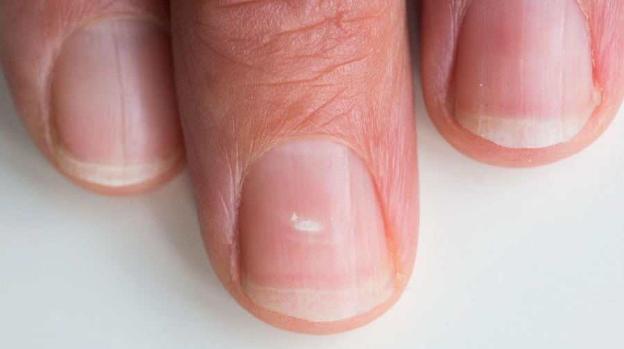 why-do-white-spots-appear-on-your-nails-healthylicius