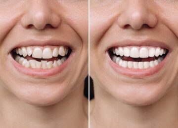 composite veneers